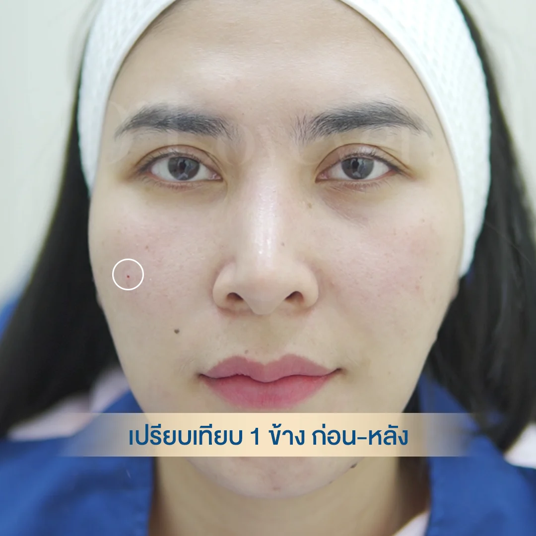 รอยเข็มฟิลเลอร์ เทียบก่อนทำ หลังทำ 1 ข้าง