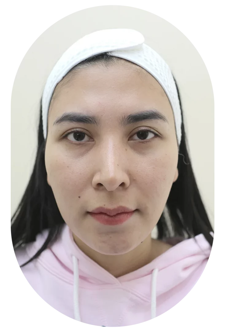 จบปัญหาร่องใต้ตา! รีวิวฟิลเลอร์ที่ D' Lovevery Clinic สวยขึ้นจนใครๆ ก็ทัก ราคาสบายกระเป๋า ใกล้บ้านคุณ!