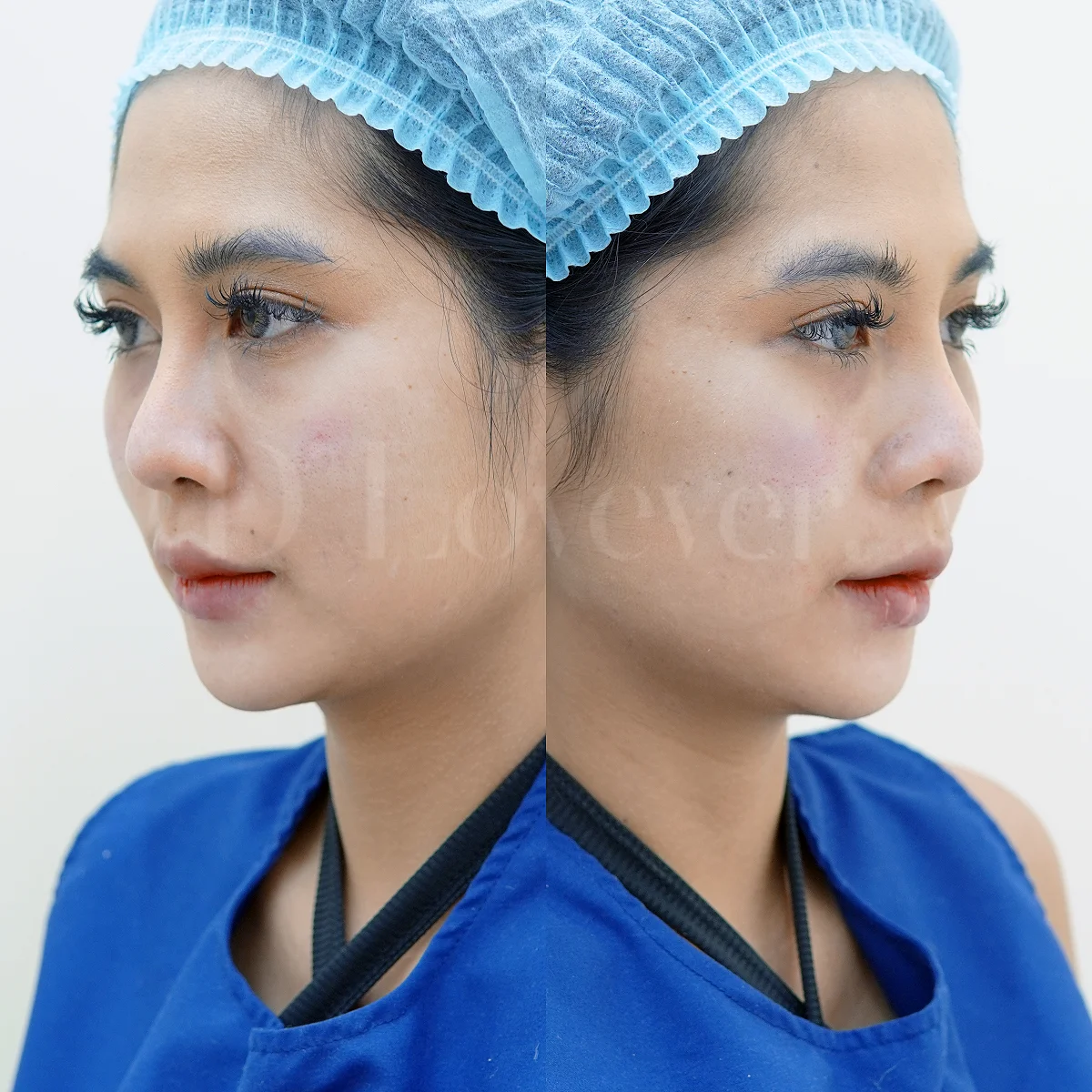 ใต้ตาคล้ำเหมือนหมีแพนด้า? ฟิลเลอร์ช่วยชีวิต!
ก่อนทำ ใต้ตาคล้ำมาก