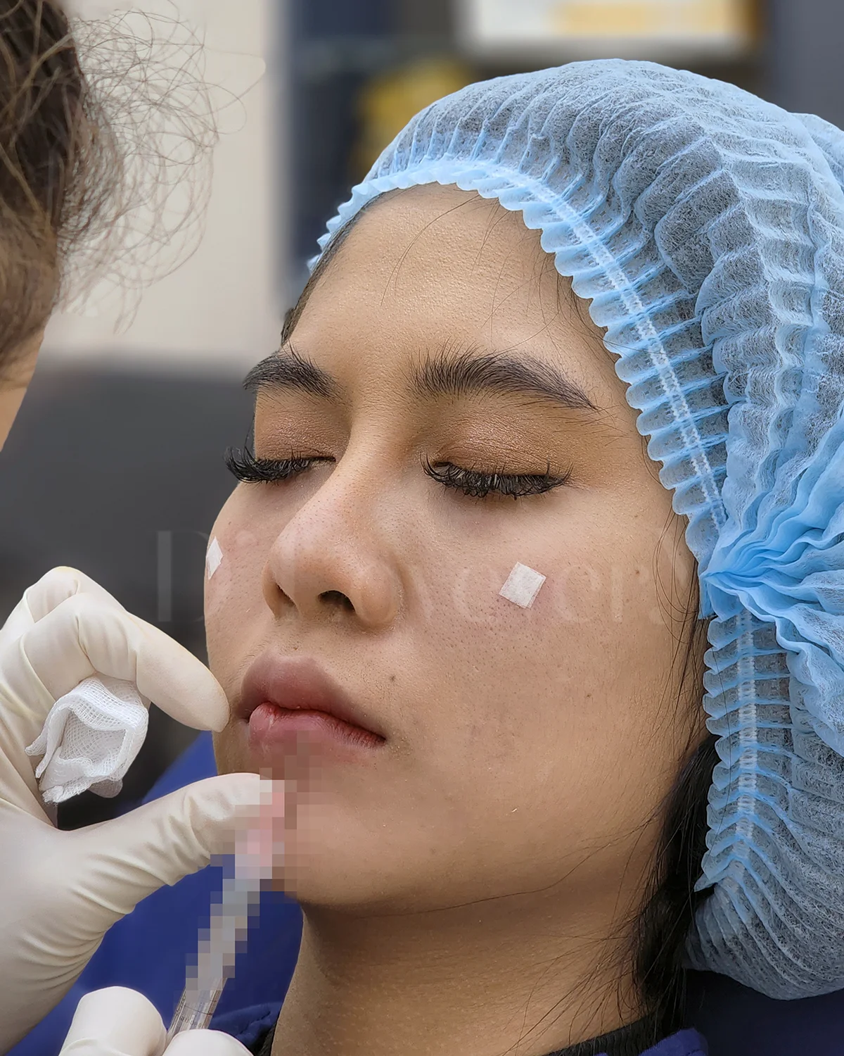 รีวิวฟิลเลอร์ใต้ตา! สวยปิ๊ง มั่นใจขึ้น 10 เท่า! ต่อด้วยฟิลเลอร์ปาก