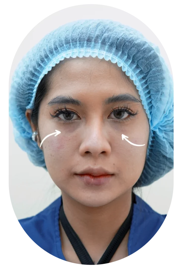 ฟิลเลอร์ใต้ตา รีวิวจากคนไข้จริง! ชีวิตเปลี่ยนจริง!