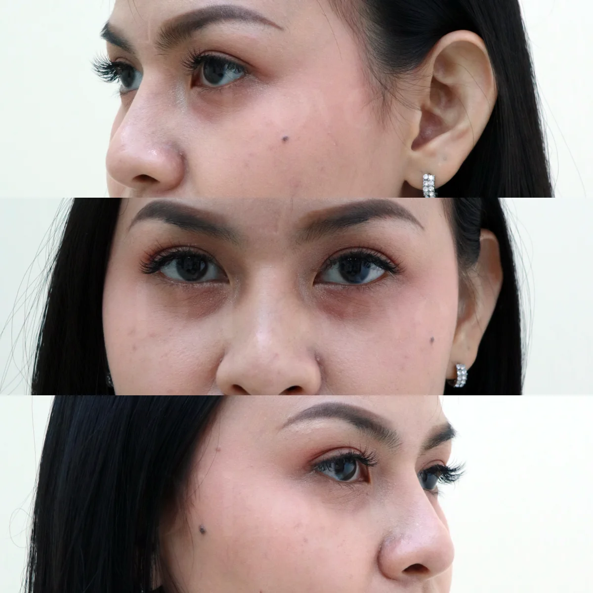 ใต้ตาโทรม ไม่สดใส ชาวเลียบด่วนฯ-รามอินทรา มาปรึกษาฟรี