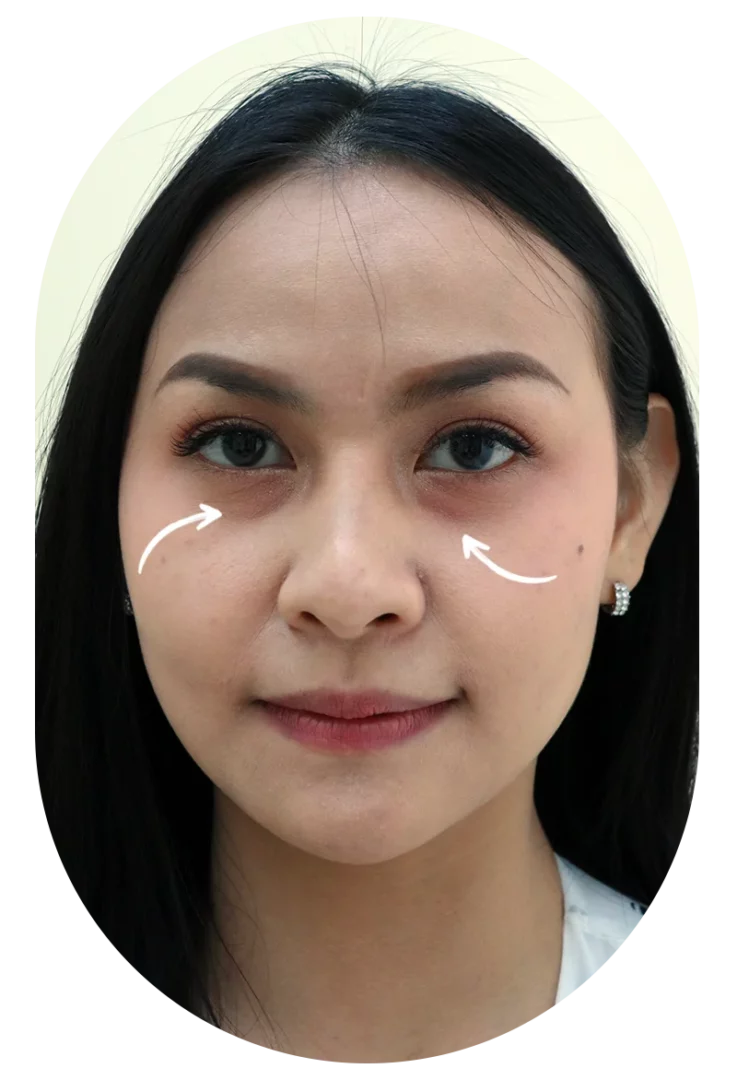 ฉีดรีวิวเกาหลี ฉีดใต้ตา ฉีดชั้นลึก เรียบเรียน ราคาย่อมเยาว์ 7999.-