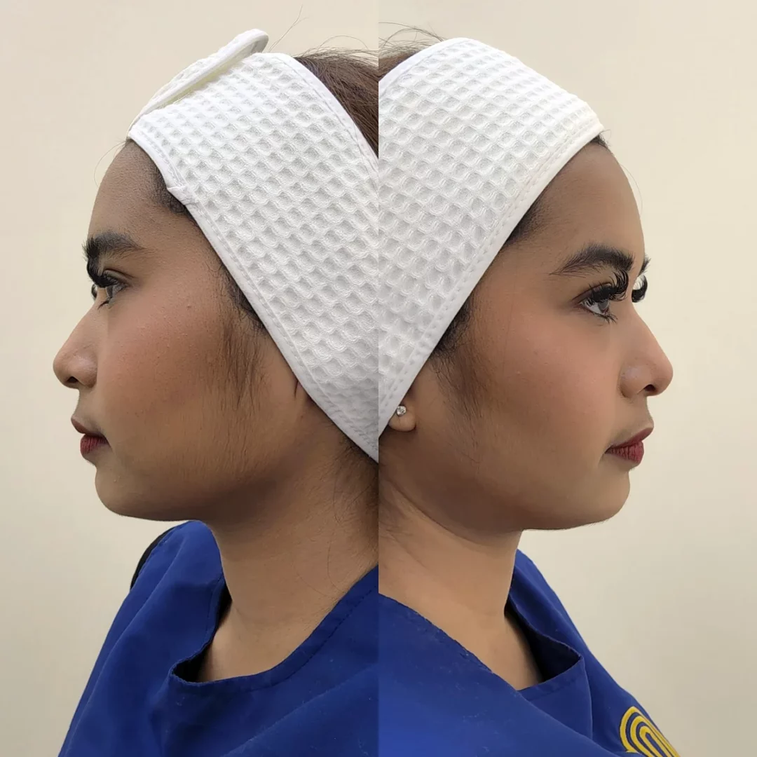 รีวิวลูกค้าจริง ย่านรามอินทรา เติมคางกับหมอต้าร์ สวยจบงบไม่บานปลาย