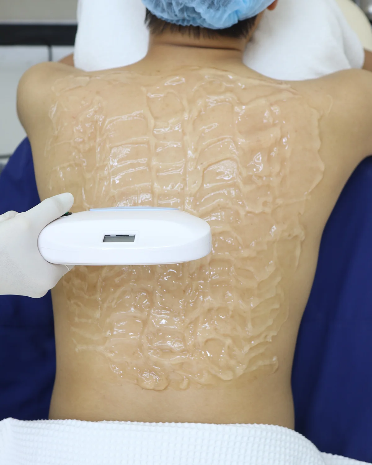 คิดว่าหายเองได้? ความเข้าใจผิดเรื่องรอยสิวที่หลัง ที่ทำให้คุณไม่กล้าถอดเสื้อ