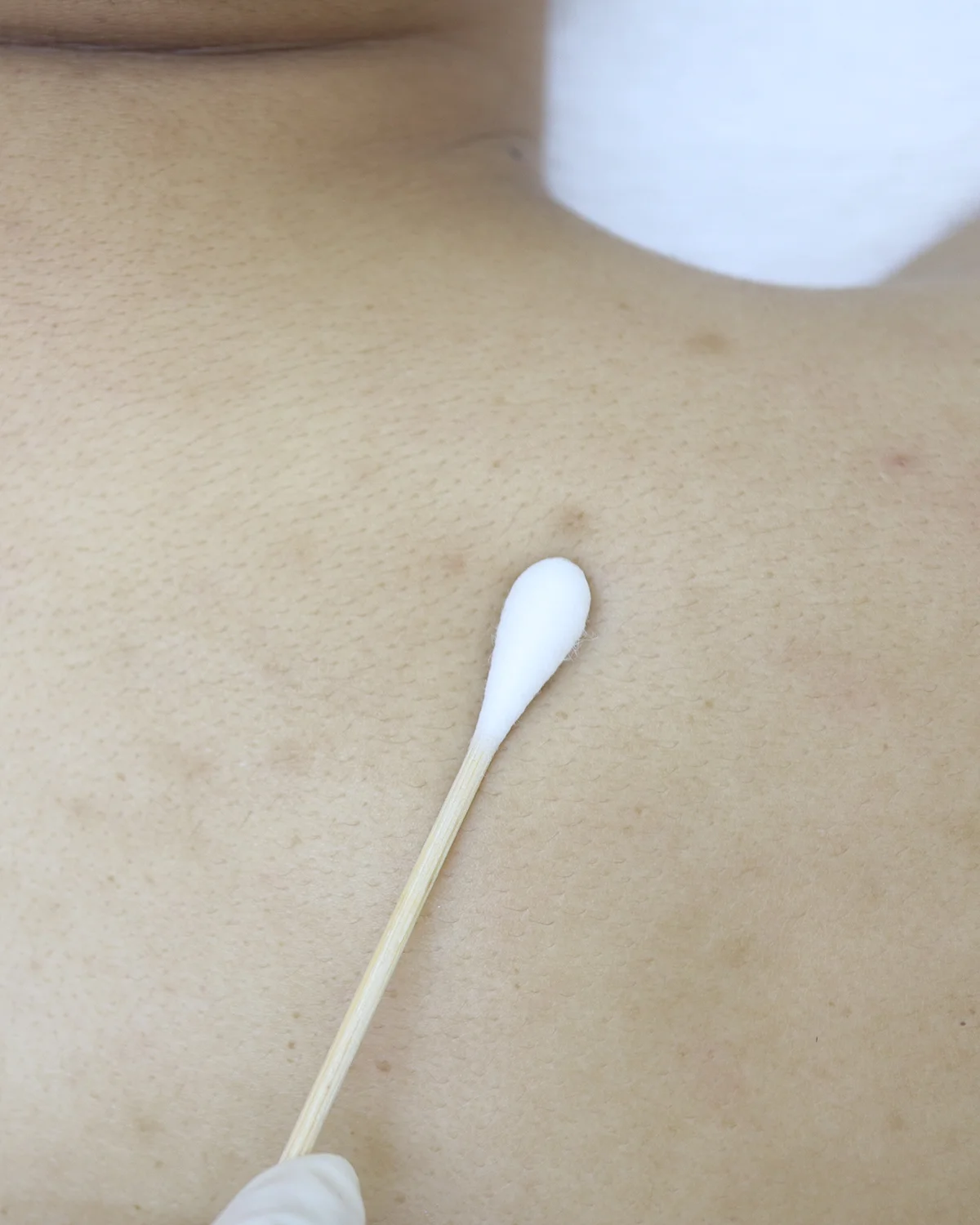 ทำไมรอยดำที่หลังถึงรักษายากกว่าหน้า? หมอตาร์มีคำตอบ