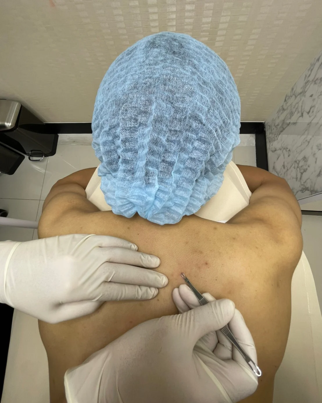 จบปัญหารอยดำกวนใจ เผยหลังเนียนใสด้วย IPL ฉบับเร่งด่วน