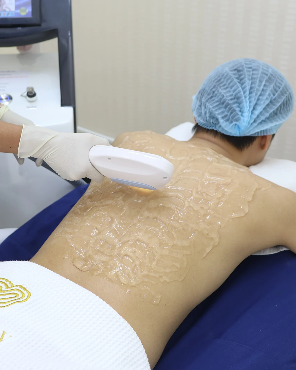 สิวหายแต่รอยไม่หาย! แชร์ประสบการณ์รักษาแผ่นหลังที่หนุ่มๆ ต้องอ่าน
