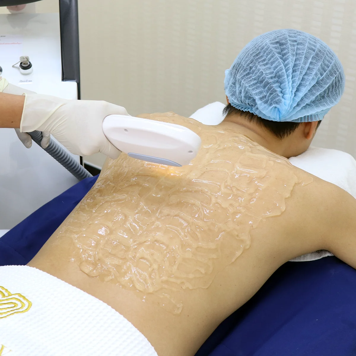 รอยสิวที่หลังฝังลึก 6 เดือน ไม่จางสักที จบได้ด้วยโปรแกรมนี้