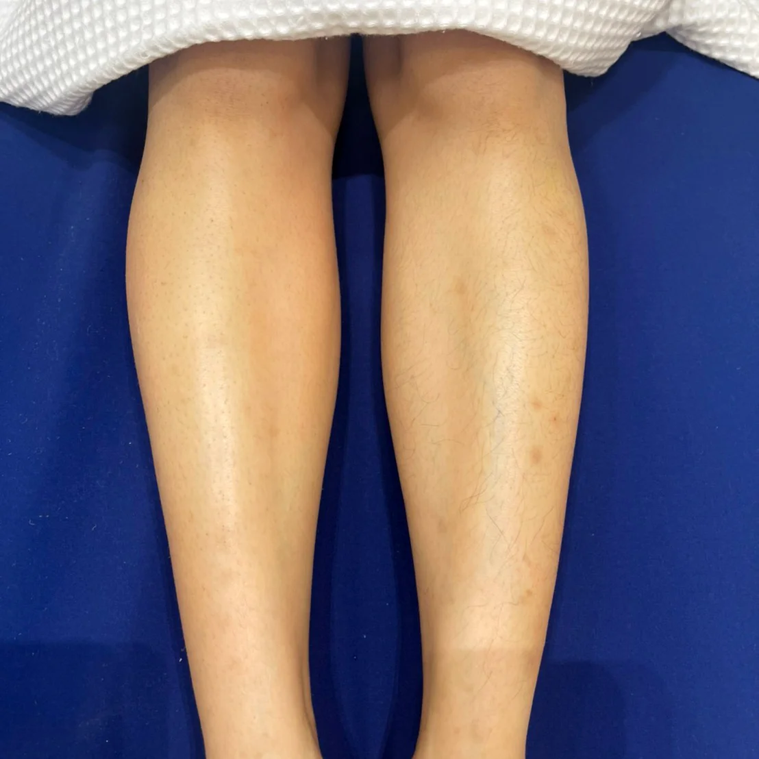 รีวิวเลเซอร์ขน D'Lovery สาขา Paseo Town และ CDC ใกล้บ้านคุณ