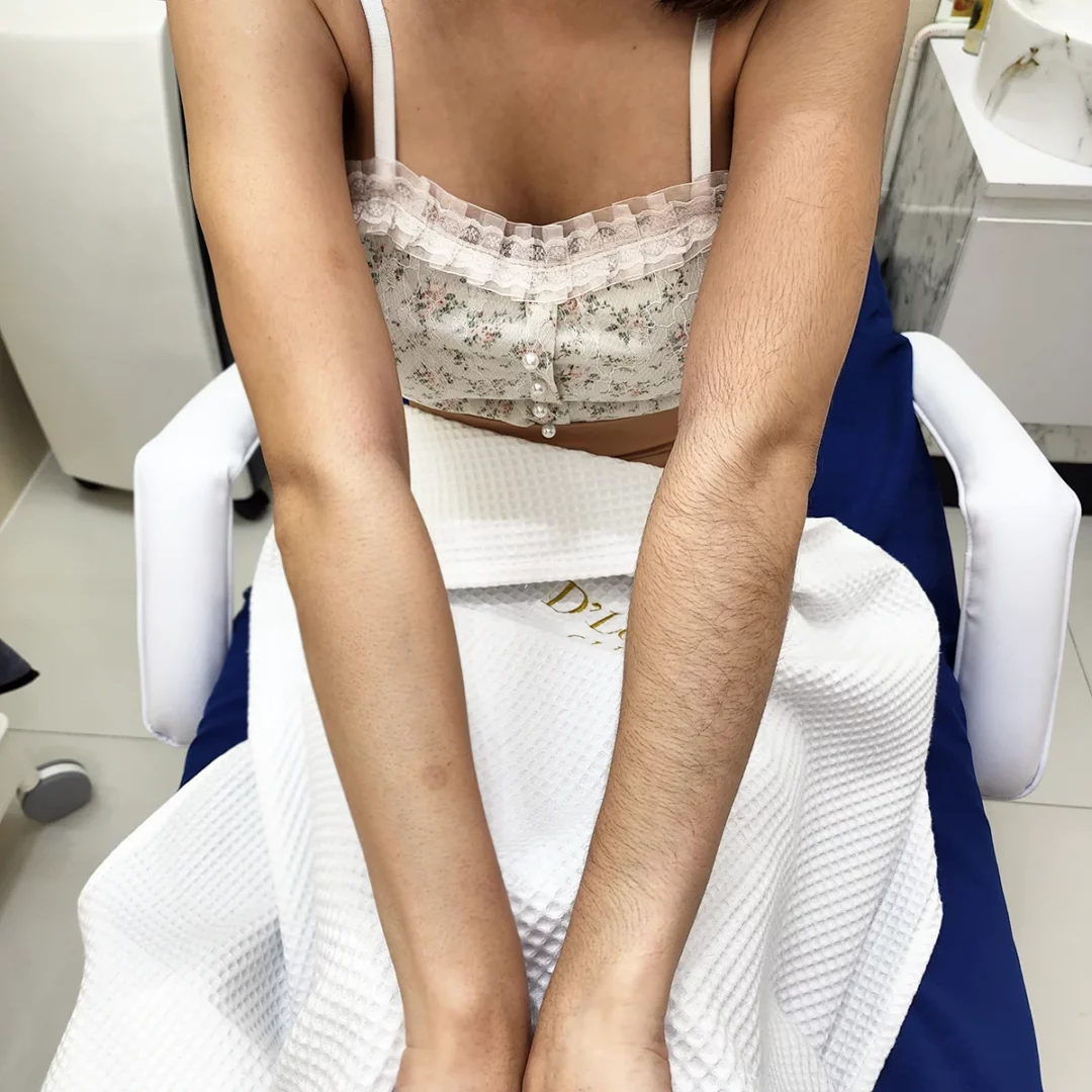 โปรโมชั่นเลเซอร์ขนขา เลียบด่วนรามอินทรา CDC ราคาดีงาม 4,000 บาท