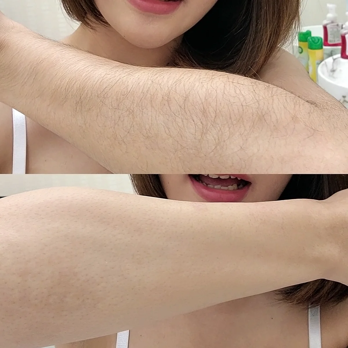 คลินิกความงามรามคำแหง เลเซอร์ขนแขน ขา ราคาแปะป้ายชัดเจน ไม่มีบวกเพิ่ม