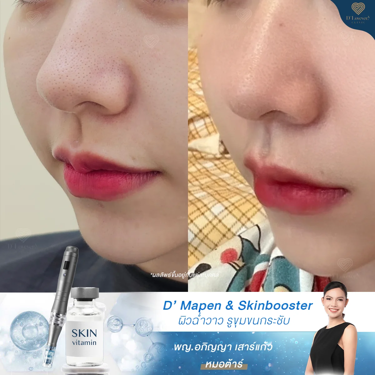 รีวิวกำจัดปัญหารูขุมขนกว้าง ฉบับคนกลัวเลเซอร์ ด้วยโปรแกรม D’ Mapen ผิวละเอียดขึ้นจนเพื่อนทัก