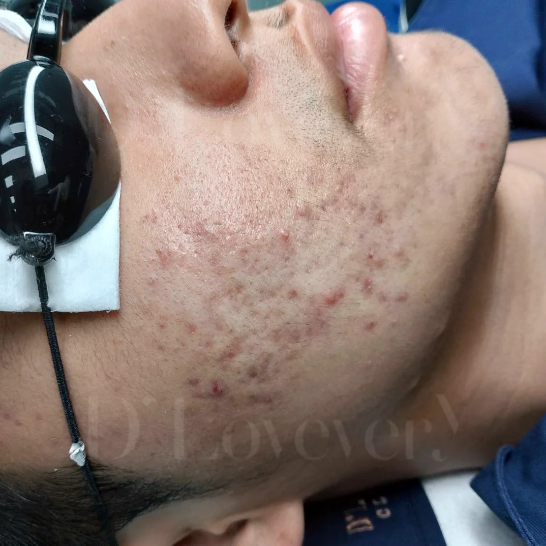 ผู้ชายก็อยากหน้าใส รวมขั้นตอนกู้หน้าพังจากสิวอักเสบ ให้กลับมามั่นใจในวัยเรียน