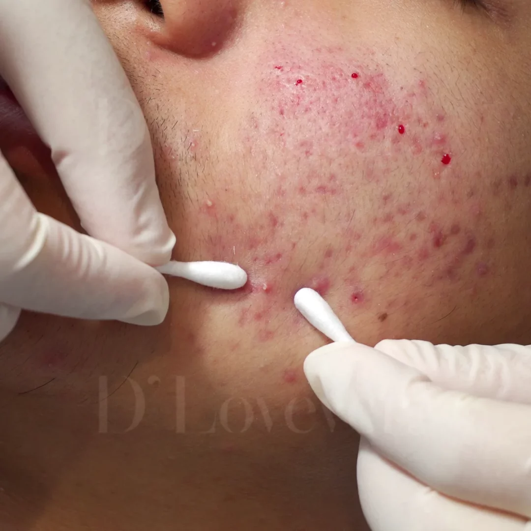 เจาะลึกโปรแกรม D' Acne L ทางออกของคนเป็นสิวเรื้อรัง กดสิว ฉายแสง จบในที่เดียว