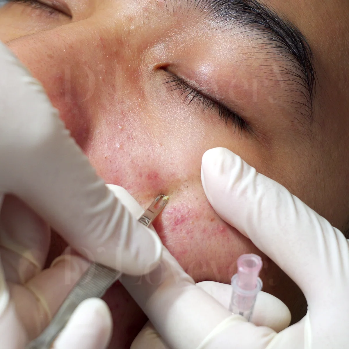 อย่าปล่อยให้สิวทำลายความมั่นใจ แชร์ประสบการณ์รักษาสิวฉบับนักเรียน งบหลักพันเอาอยู่