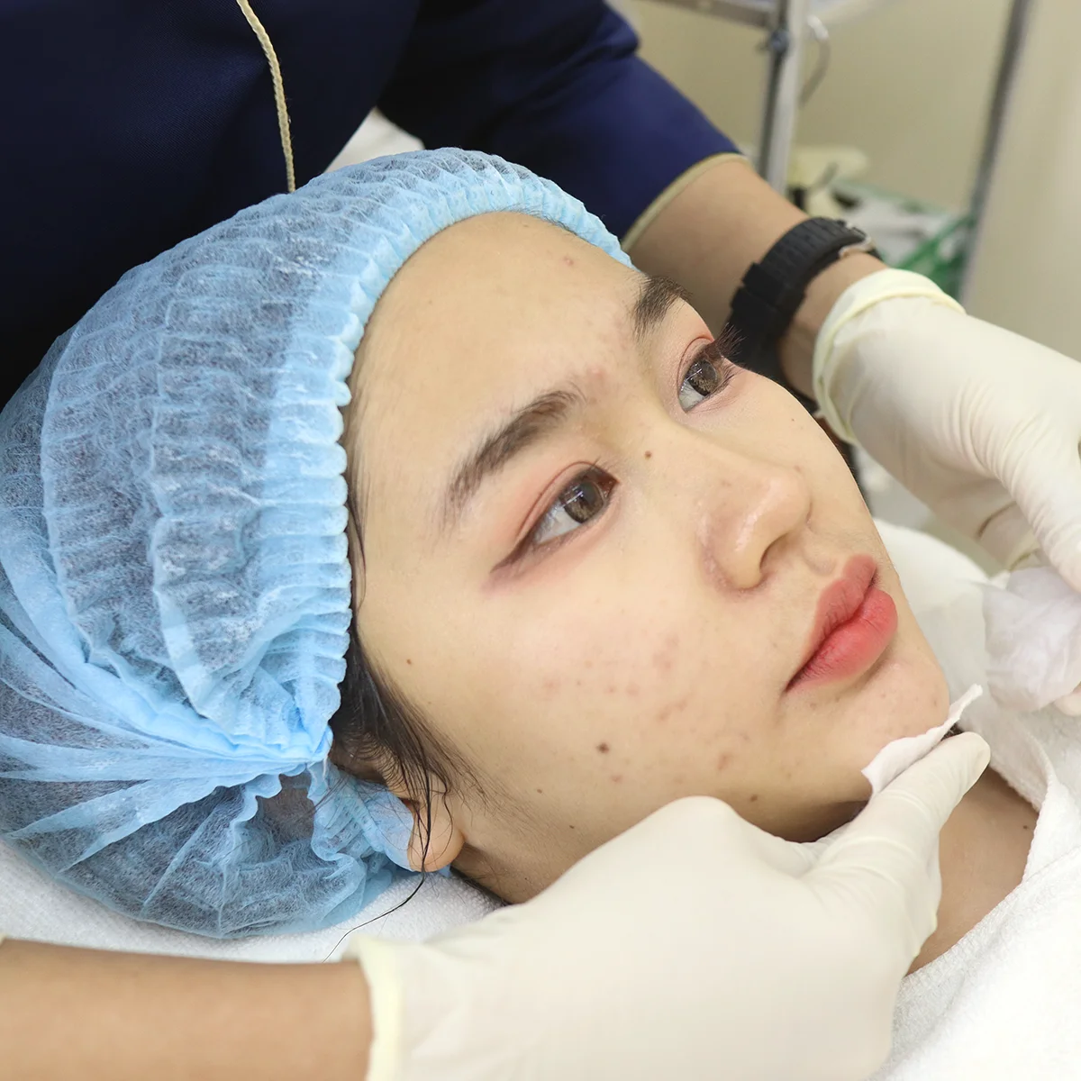 เลิกร้องไห้เพราะสิว! เปิดเคสกู้หน้าพังให้กลับมาปัง กดสิว+เลเซอร์ ครบจบในที่เดียว