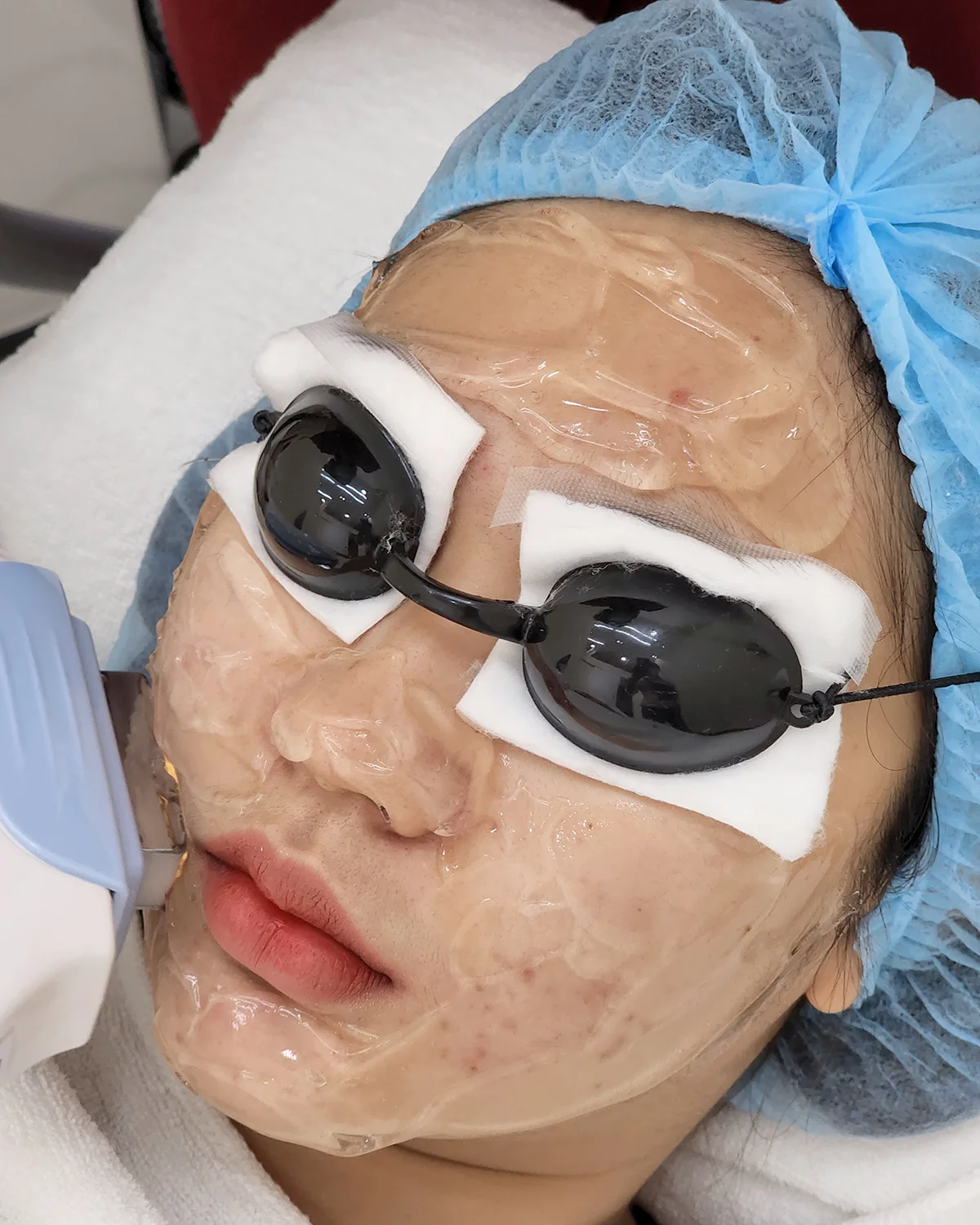 แฉหมดเปลือก! เบื้องหลังการกดสิวและยิง IPL ที่ทำให้หน้ากลับมาเนียนใสอีกครั้ง