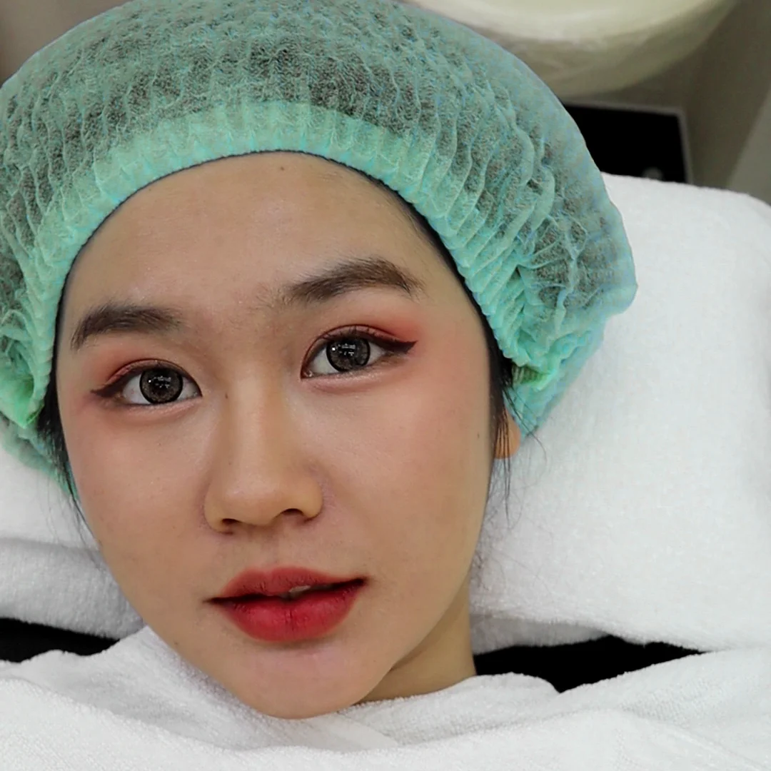 90% ของลูกค้ากลับมาซ้ำ! รีวิวรักษาหลุมสิวและรอยแดง เห็นผลจริงตั้งแต่คอร์สแรก