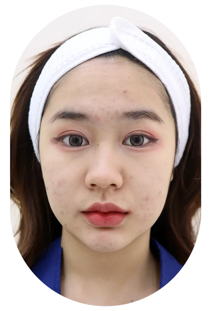 ชาวรามคำแหงต้องรู้! รักษาสิวราคาดี เริ่มต้นหลักพัน ที่ The Paseo Town