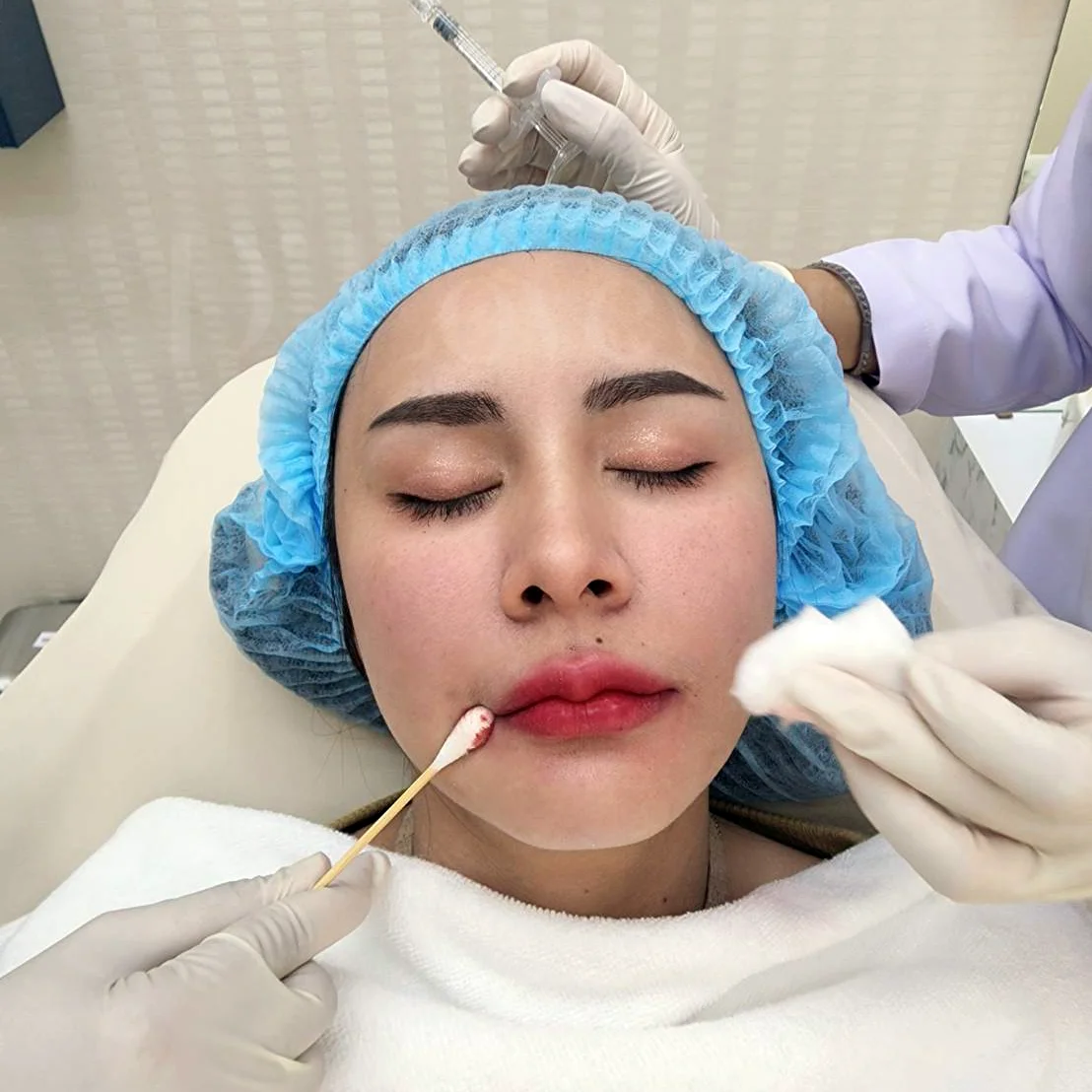 ปากบางทาลิปตกร่อง แก้ได้ด้วยฟิลเลอร์ปาก ริมฝีปากบนไม่เท่ากัน มีรู ก็แก้ไขได้