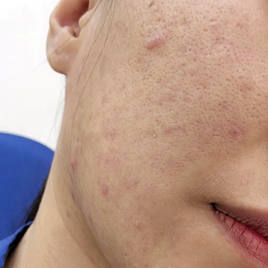 เป็นสิวอย่าปล่อยไว้นาน จะกลายเป็นหลุมสิว ที่รักษายากมากขึ้น ใช้โปรแกรมหลายตัว ค่าใช้จ่ายแพงมากขึ้น