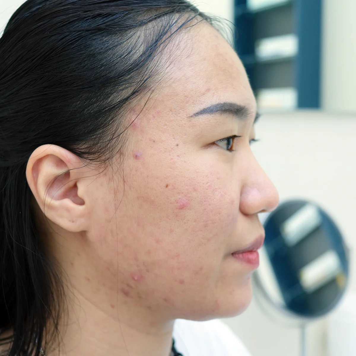 อย่าปล่อยให้ "สิวหน้ากาก" ทำลายโอกาสดีๆ ในชีวิตคุณ