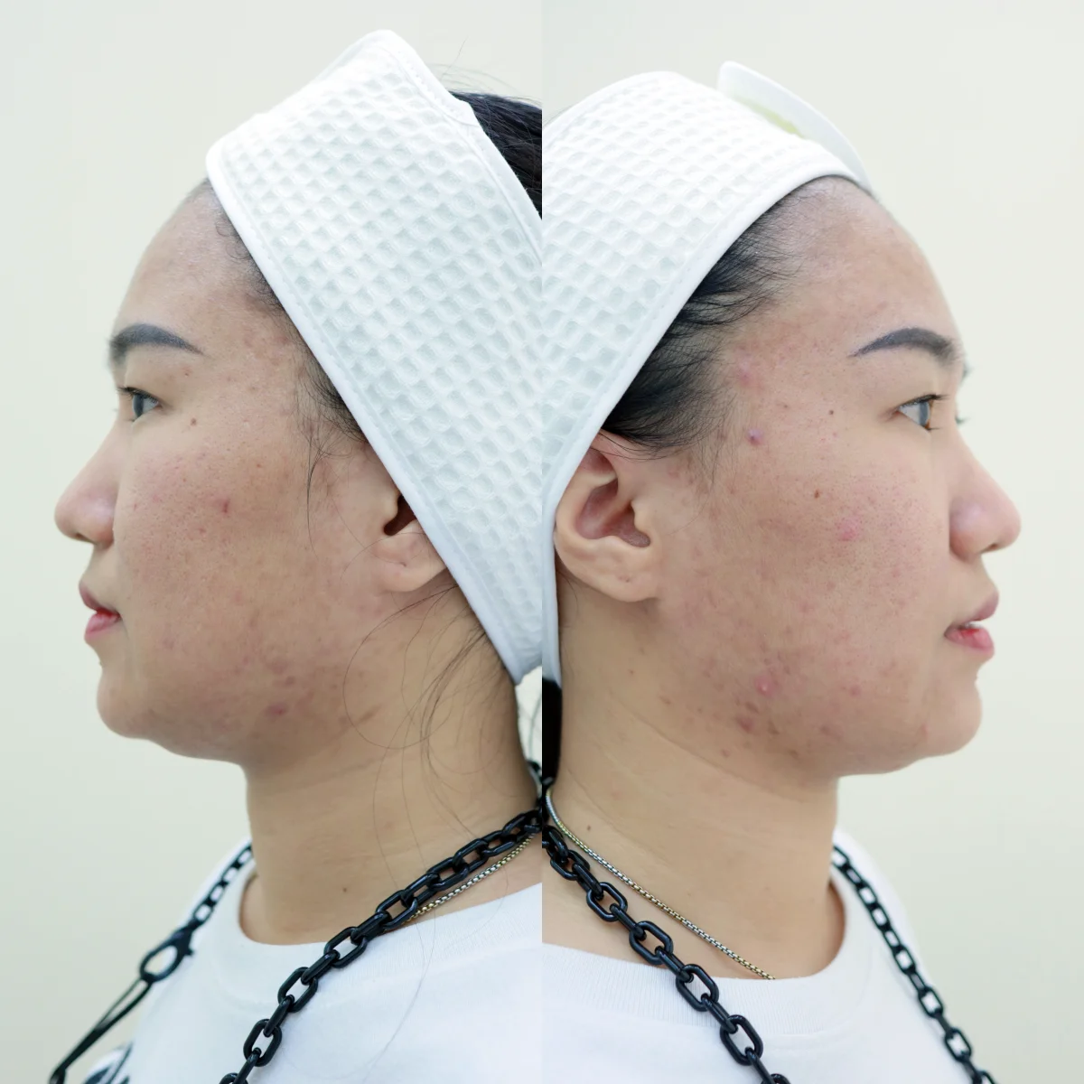 เผยหมดเปลือก ขั้นตอนรักษาสิวฉบับคนไม่มีเวลา แวะมาทำสวยได้หลังเลิกงาน