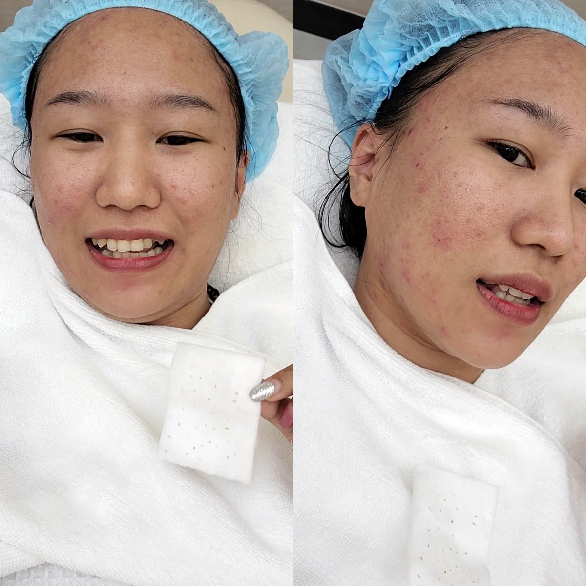 ถอดแมสไม่ได้เพราะสิวรุม? รีวิวหมดเปลือก รักษาสิวฉบับคนไม่มีเวลา แวะมาทำสวยได้หลังเลิกงาน