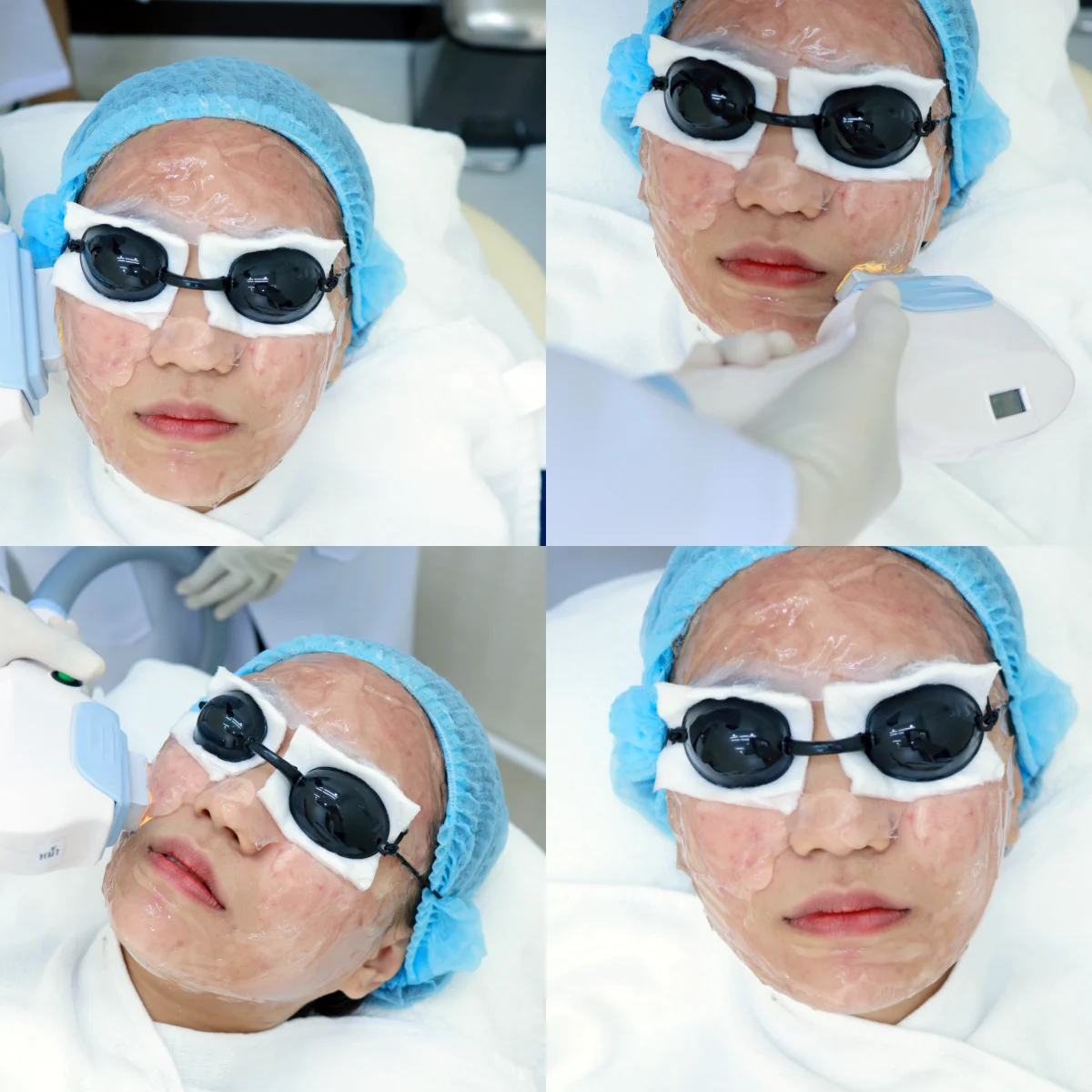 หาคลินิกความงาม ใกล้ ARL รามคำแหง รักษาสิว หลุมสิว ราคาไม่แพง