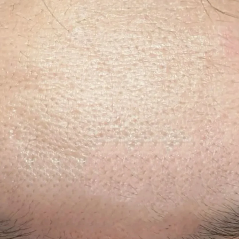 รูขุมขนกว้างบนหน้าผาก จมูก ทำไงดี? หมอผิวหนังแนะนำโปรแกรมเลเซอร์, Microdermabrasion, Chemical Peeling, Microneedling พร้อมเคล็ดลับดูแลผิว