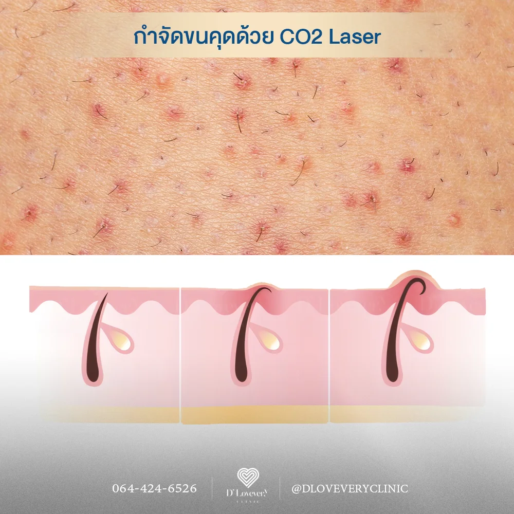 CO2 Laser รักษาขนคุดได้จริงไหม? แพทย์ความงามอธิบายหลักการทำงาน วิธีการรักษา จำนวนครั้งที่ต้องทำ เพื่อผิวเรียบเนียนไร้ตุ่มกวนใจ บอกลาปัญหาขนคุด
