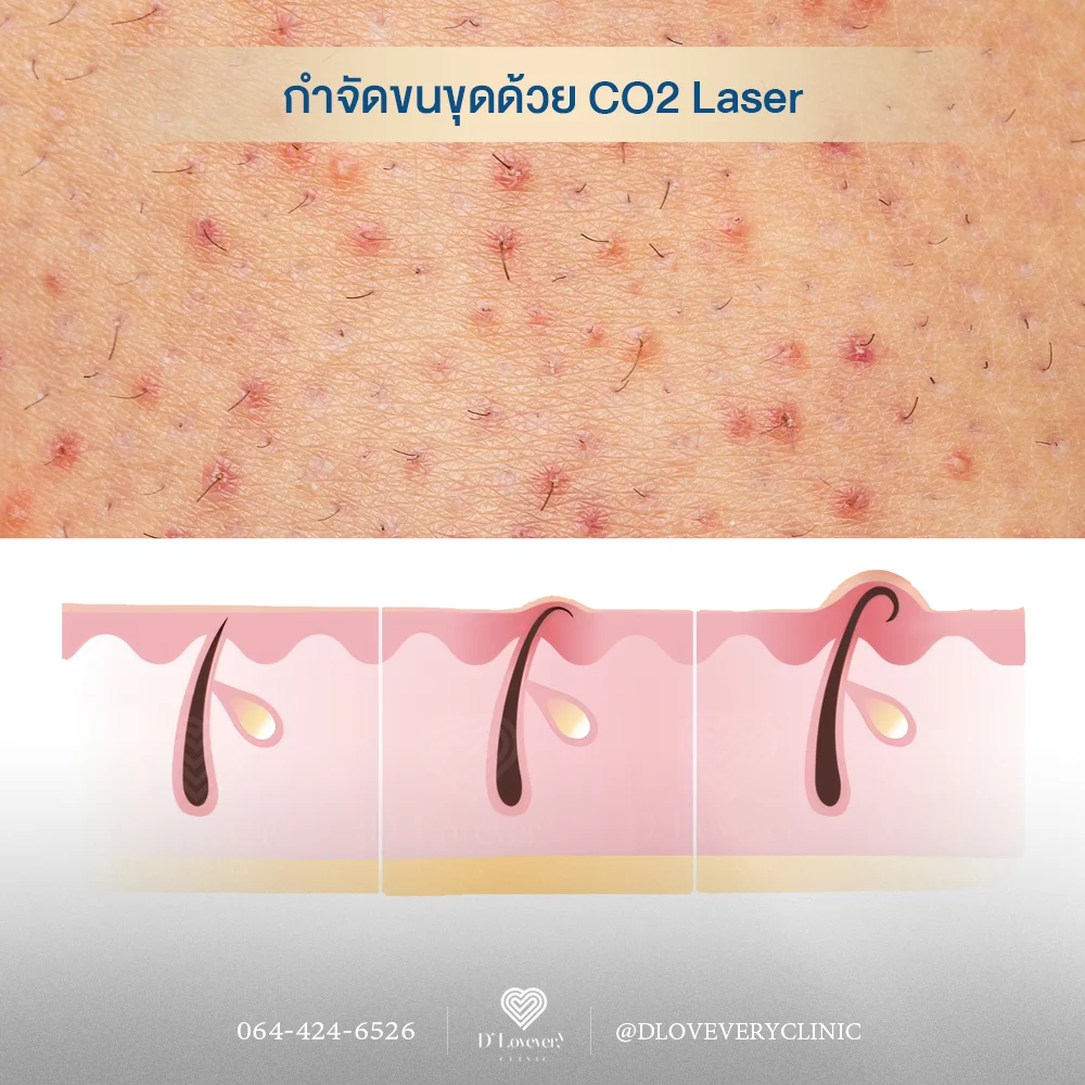 CO2 Laser รักษาขนคุดได้จริงไหม? แพทย์ความงามอธิบายหลักการทำงาน วิธีการรักษา จำนวนครั้งที่ต้องทำ เพื่อผิวเรียบเนียนไร้ตุ่มกวนใจ บอกลาปัญหาขนคุด