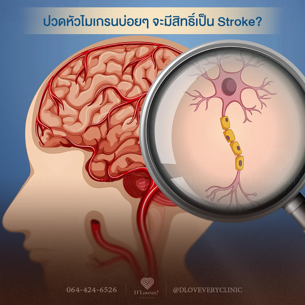 ปวดหัวไมเกรนบ่อยเสี่ยงอัมพฤกษ์จริงไหม? หมอเล่าความเชื่อมโยงระหว่างไมเกรนกับโรคหลอดเลือดสมอง (Stroke) โดยเฉพาะกลุ่มมีอาการเตือน (Aura) พร้อมแนวทางป้องกันที่คุณควรรู้
