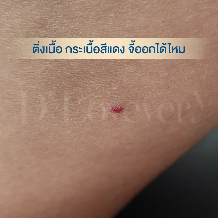 กระแดง ขี้แมลงวันสีแดง กระเนื้อสีแดง ติ่งเนื้อสีแดง จี้ออก กำจัดได้ไหม