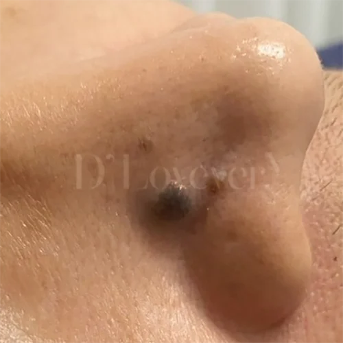 ไฝที่จมูก นูนแข็งสีดำ เอาออกได้ไหม? หมอแนะนำวิธีรักษาด้วย CO2 Laser กำจัดไฝถาวร ไม่เจ็บ แผลเนียนหายไว พร้อมวิธีเช็กไฝอันตรายก่อนตัดสินใจ ปรึกษาหมอคลิกเลย!