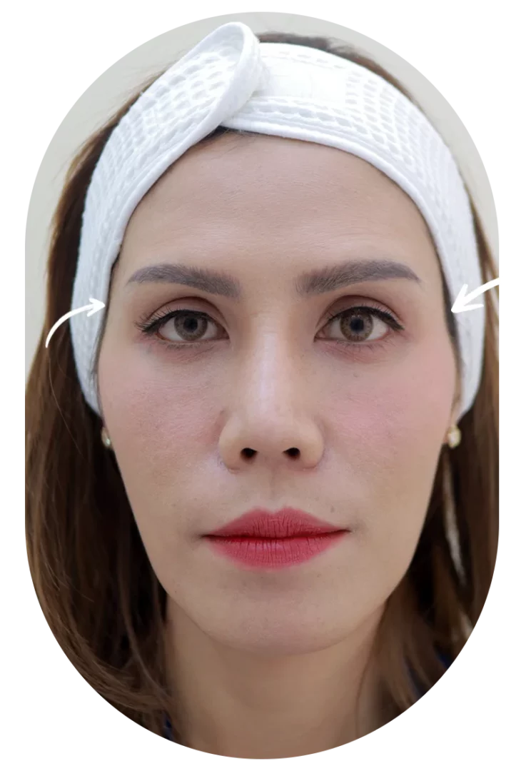 หน้าไม่ละมุน แต่งหน้าไม่ขึ้น เช็คด่วน! คุณอาจกำลังเจอปัญหา ขมับลึก ทำให้โหนกแก้มชัดเกินจริง