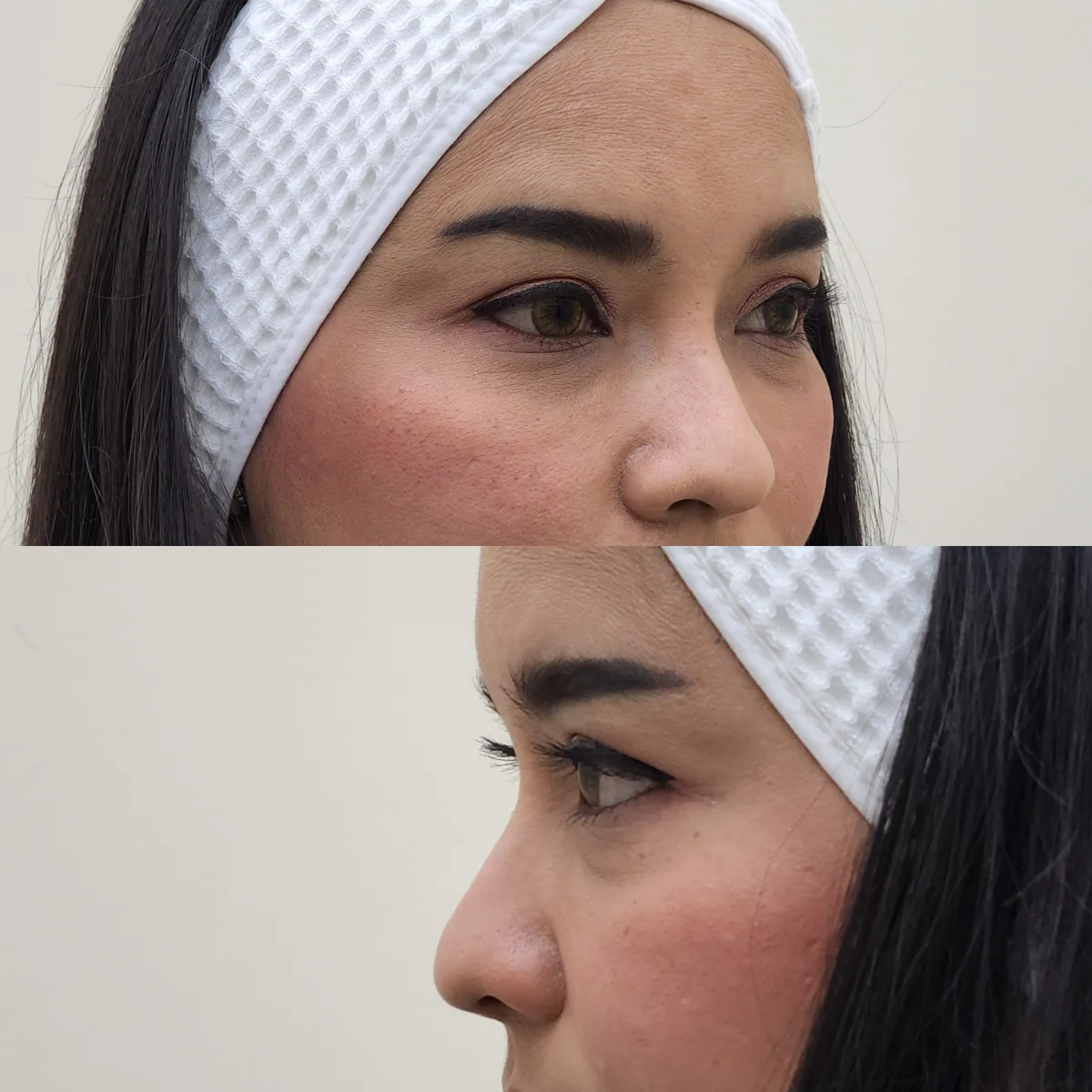 หน้าโทรมเพราะอดนอน หรือโครงหน้าทรุด? เช็คด่วนก่อนสายเกินแก้
