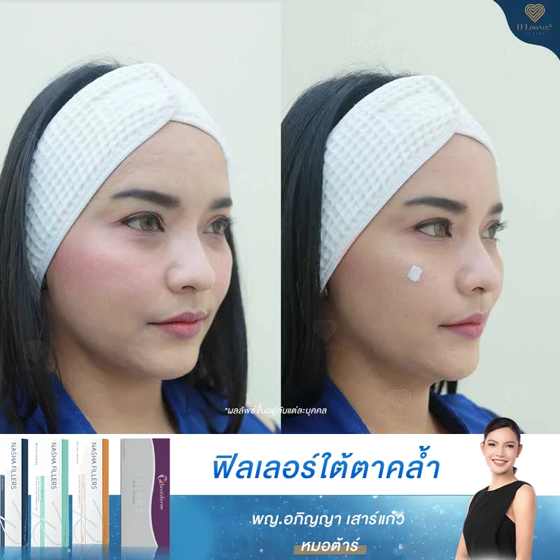 โปรโมชั่นฉีดใต้ตา ย่าน CDC เลียบด่วน ราคาโดนใจสาวออฟฟิศ