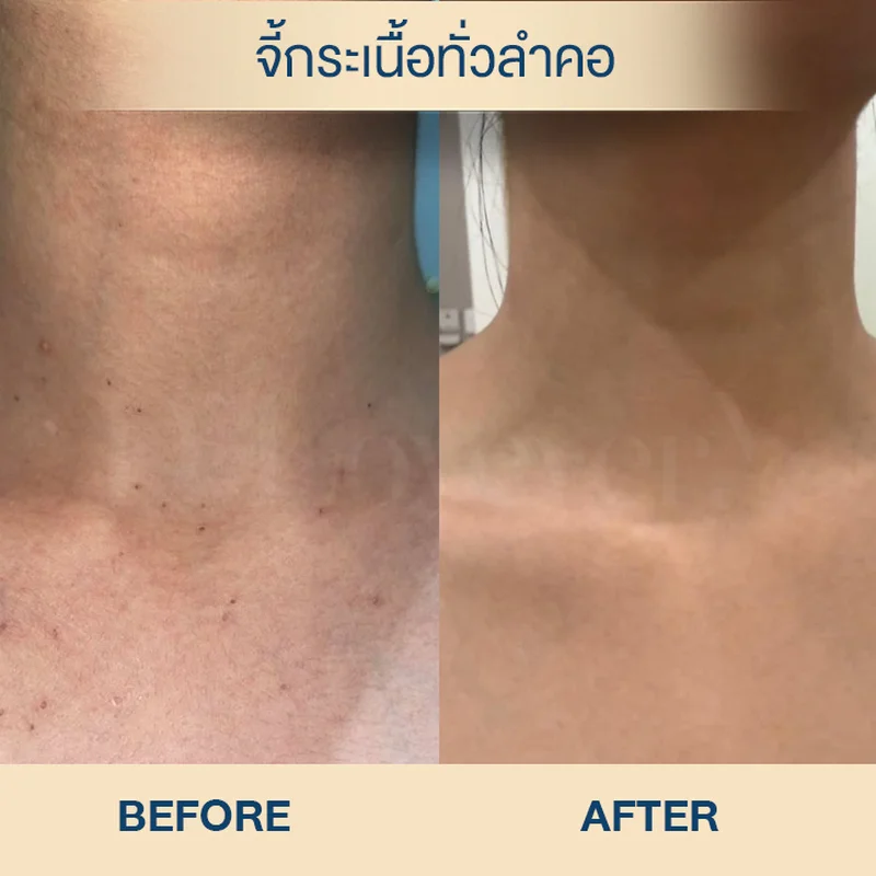 โดยทั่วไปกระบวนการผลัดเซลล์ผิวจนสะเก็ดหลุดสมบูรณ์จะใช้เวลาเฉลี่ย 5-7 วัน