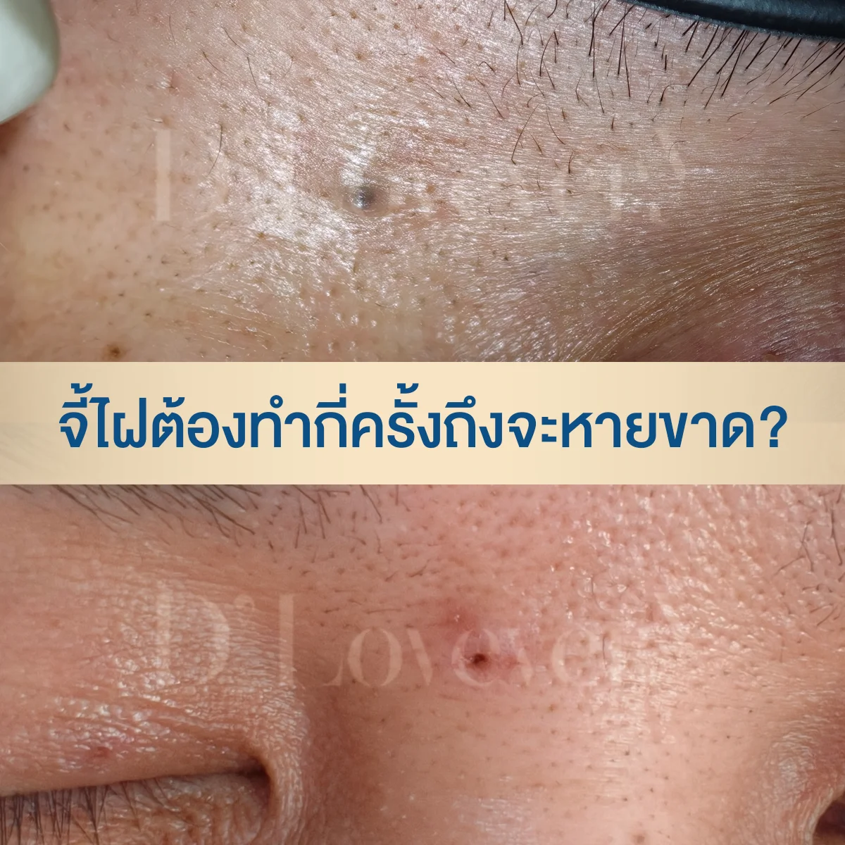 จี้ไฝกี่ครั้งหายขาด? หมอแนะความจริงเรื่องไฝรากลึก ทำไมบางคนจี้ทีเดียวจบ แต่บางคนต้องซ้ำ? พร้อมวิธีดูแลแผลไม่ให้เป็นหลุม และไม่ให้ไฝกลับมาอีก คลิกอ่านเลย!