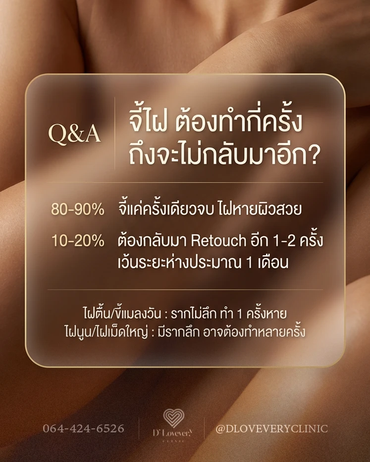 จี้ไฝกี่ครั้งหายขาด? หมอแนะความจริงเรื่องไฝรากลึก ทำไมบางคนจี้ทีเดียวจบ แต่บางคนต้องซ้ำ? พร้อมวิธีดูแลแผลไม่ให้เป็นหลุม และไม่ให้ไฝกลับมาอีก คลิกอ่านเลย!