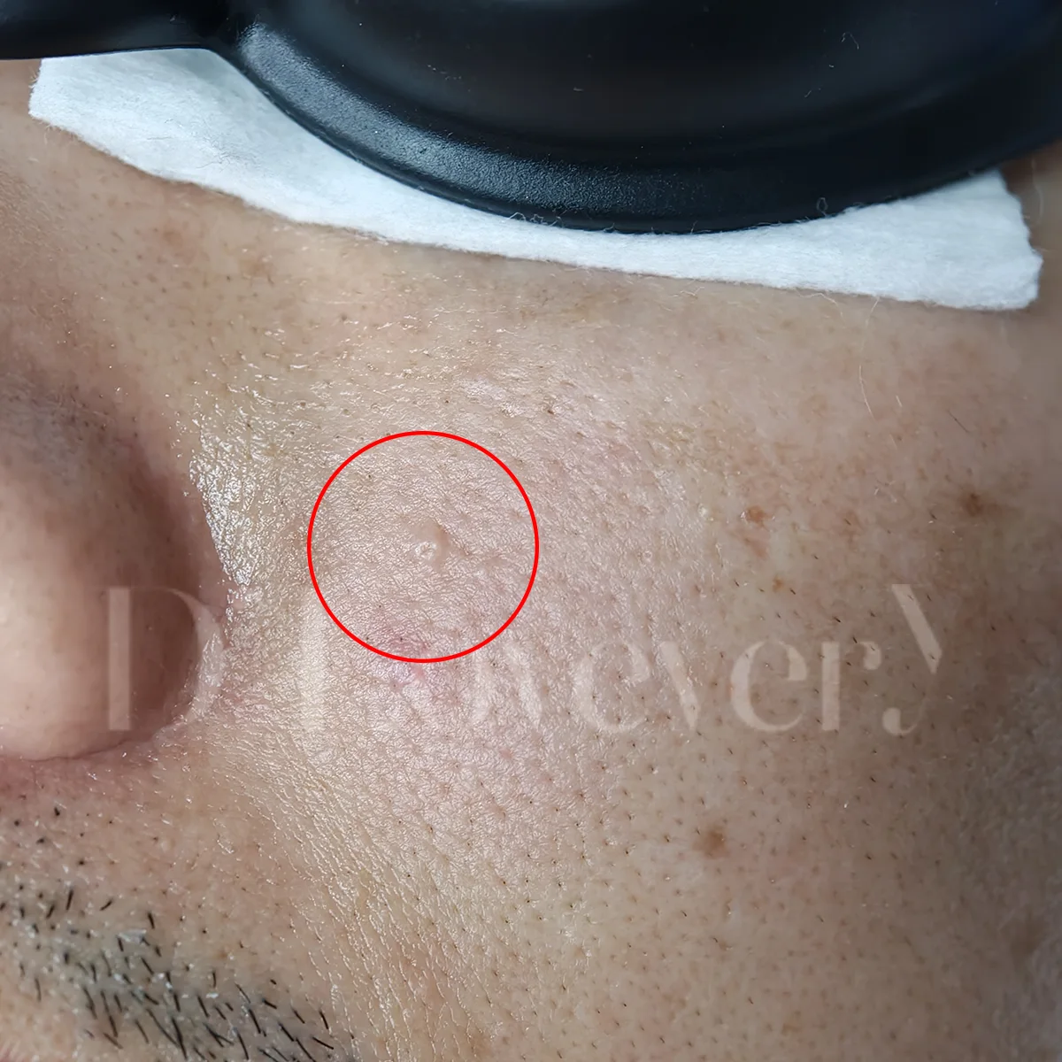 สิวอุดตัน สิวหิน หรือต่อมไขมันโต ต้องจี้ด้วย CO2 Laser ถึงจะหาย! หมอสรุปวิธีแยกประเภทสิวที่ต้องทำเลเซอร์ พร้อมเหตุผลว่าทำไมทายาถึงไม่หาย คลิกอ่านเลย