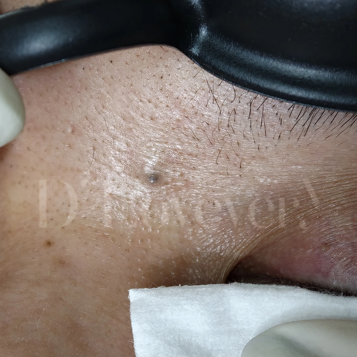 ไฝลึกได้แค่ไหน? ลึกถึงกระดูกจริงไหม? หมอพามาไขคำตอบโครงสร้างรากไฝ พร้อมวิธีสังเกตไฝอันตรายและการกำจัดไฝที่ถูกต้อง ปลอดภัย ไม่ทิ้งรอยแผลเป็น คลิกอ่านเลย!