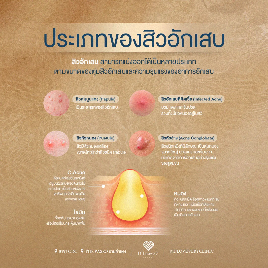 ต้นตอของหลุมสิว ส่วนใหญ่คือสิวอักเสบ