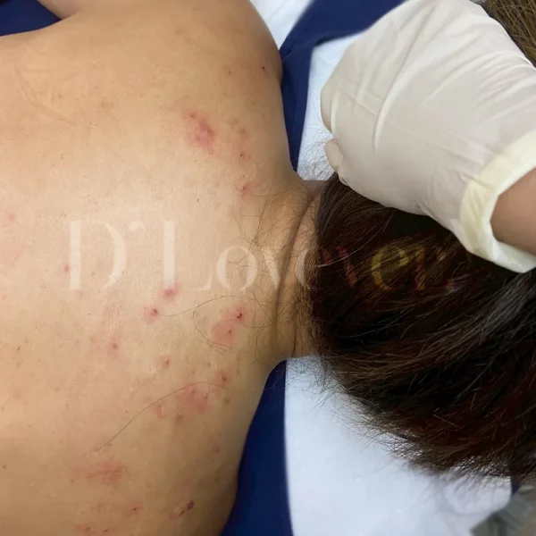 ทำไมต้องทำ รักษาสิว รอยสิวที่หลัง ที่ D’ Lovevery Clinic