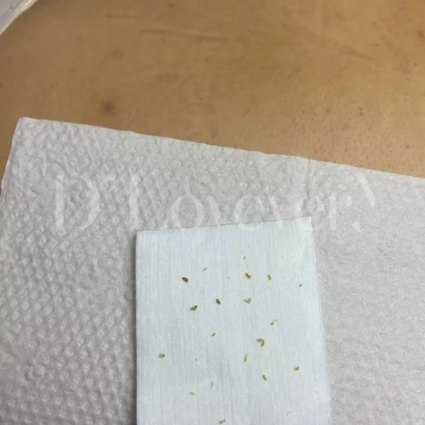 ทำไมต้องทำ รักษาสิว รอยสิวที่หลัง ที่ D’ Lovevery Clinic