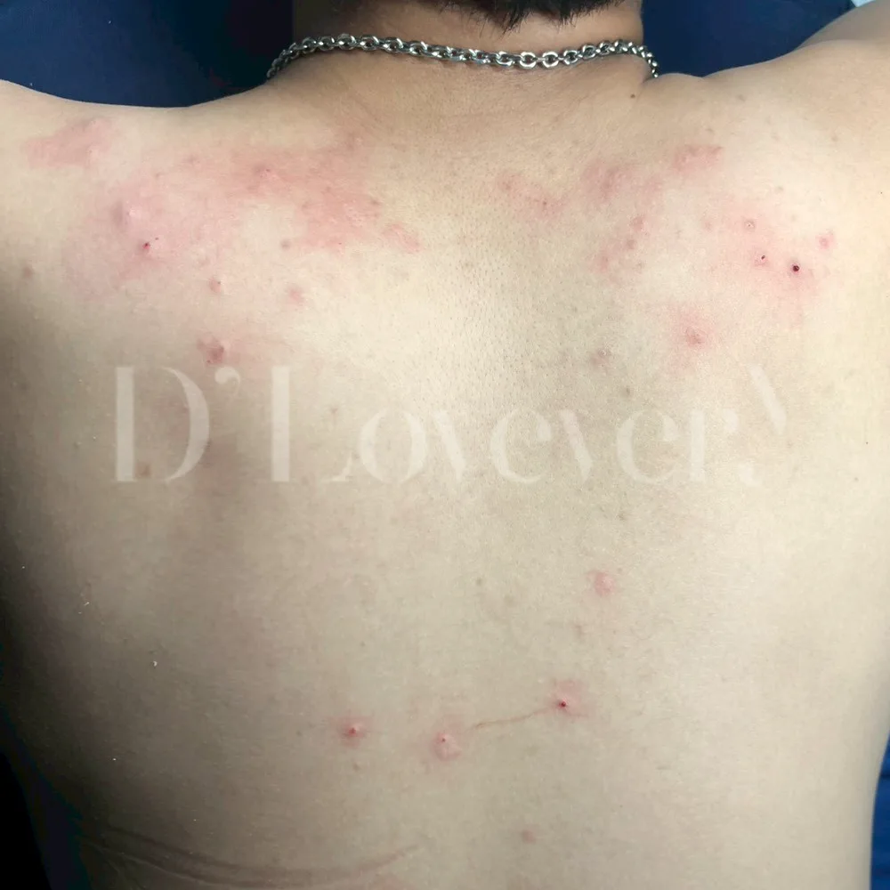 ทำไมต้องทำ รักษาสิว รอยสิวที่หลัง ที่ D’ Lovevery Clinic