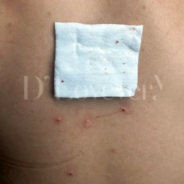 ทำไมต้องทำ รักษาสิว รอยสิวที่หลัง ที่ D’ Lovevery Clinic