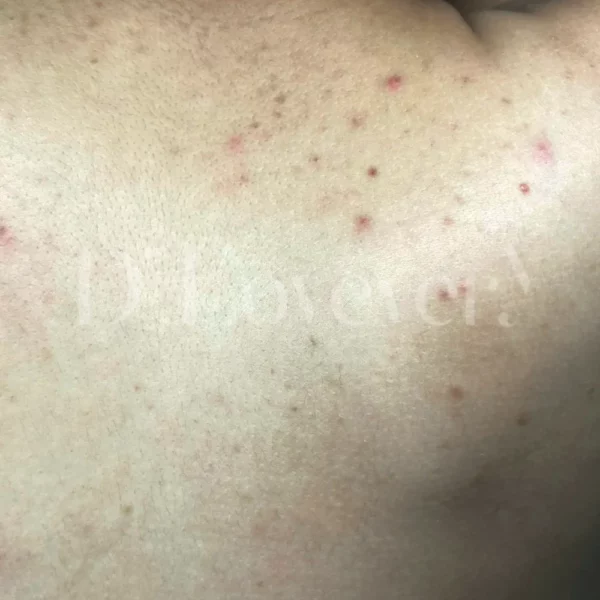 ทำไมต้องทำ รักษาสิว รอยสิวที่หลัง ที่ D’ Lovevery Clinic